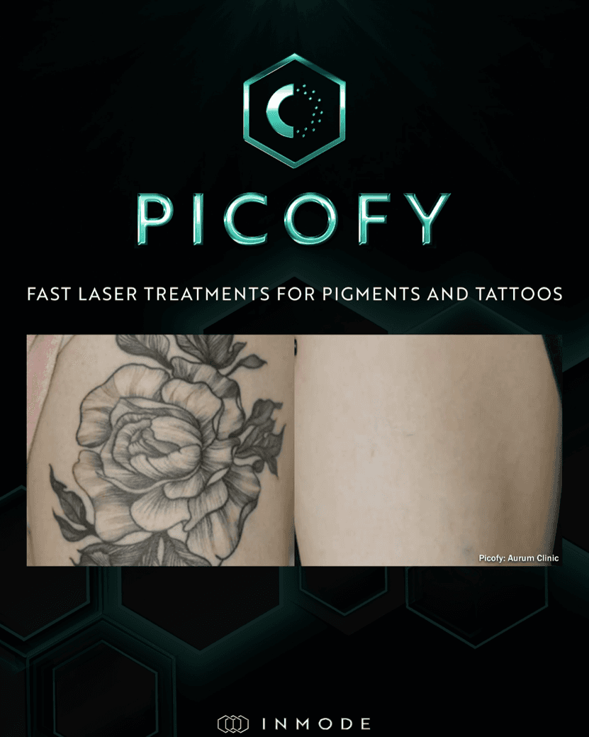 Tattoo Removal