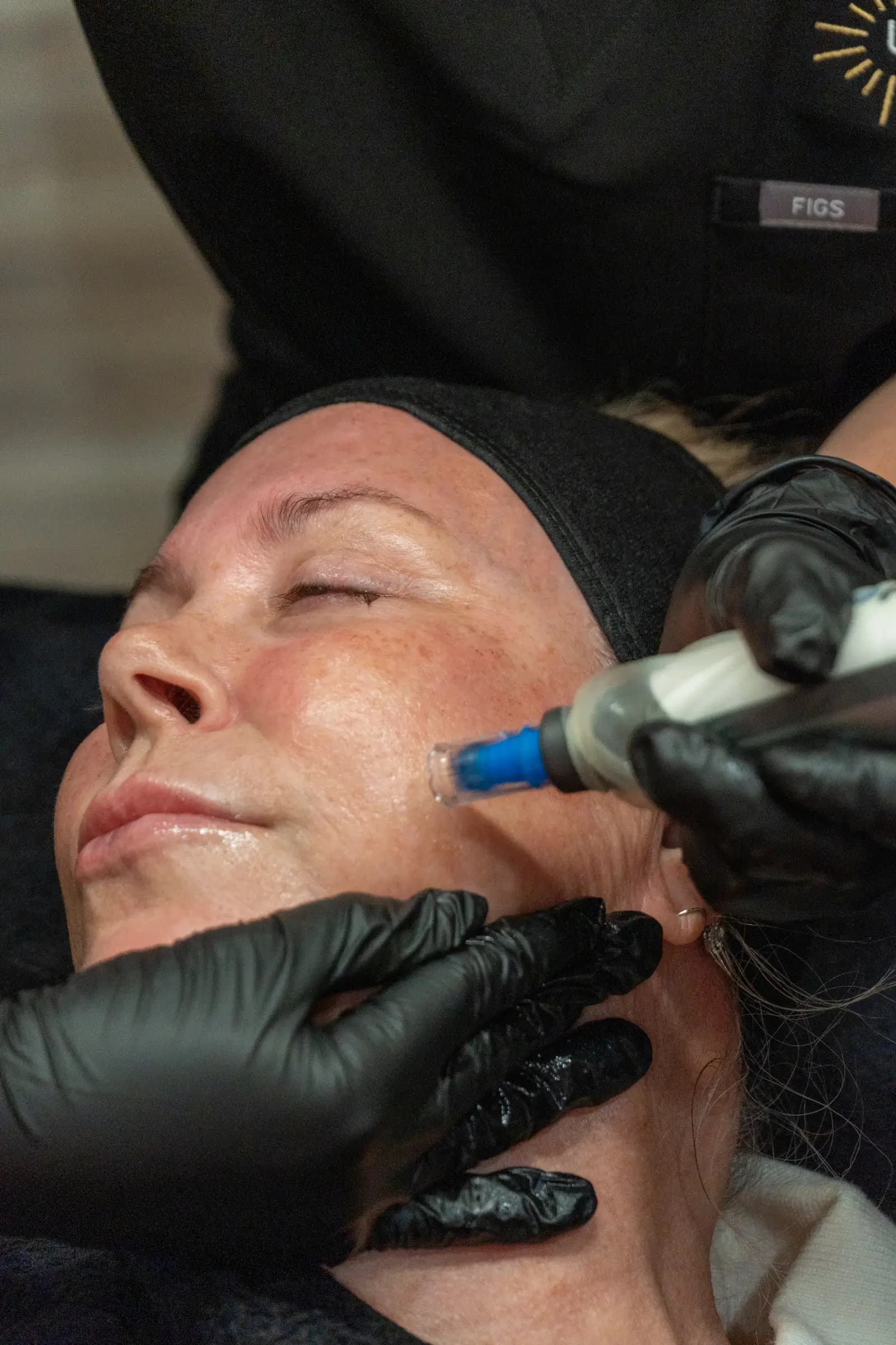 A radiofrequency handpiece being passed over a client's cheek